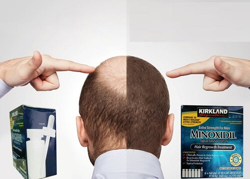 Thuốc mọc tóc Minoxidil ngăn rụng tóc, kích thích mọc tóc hiệu quả